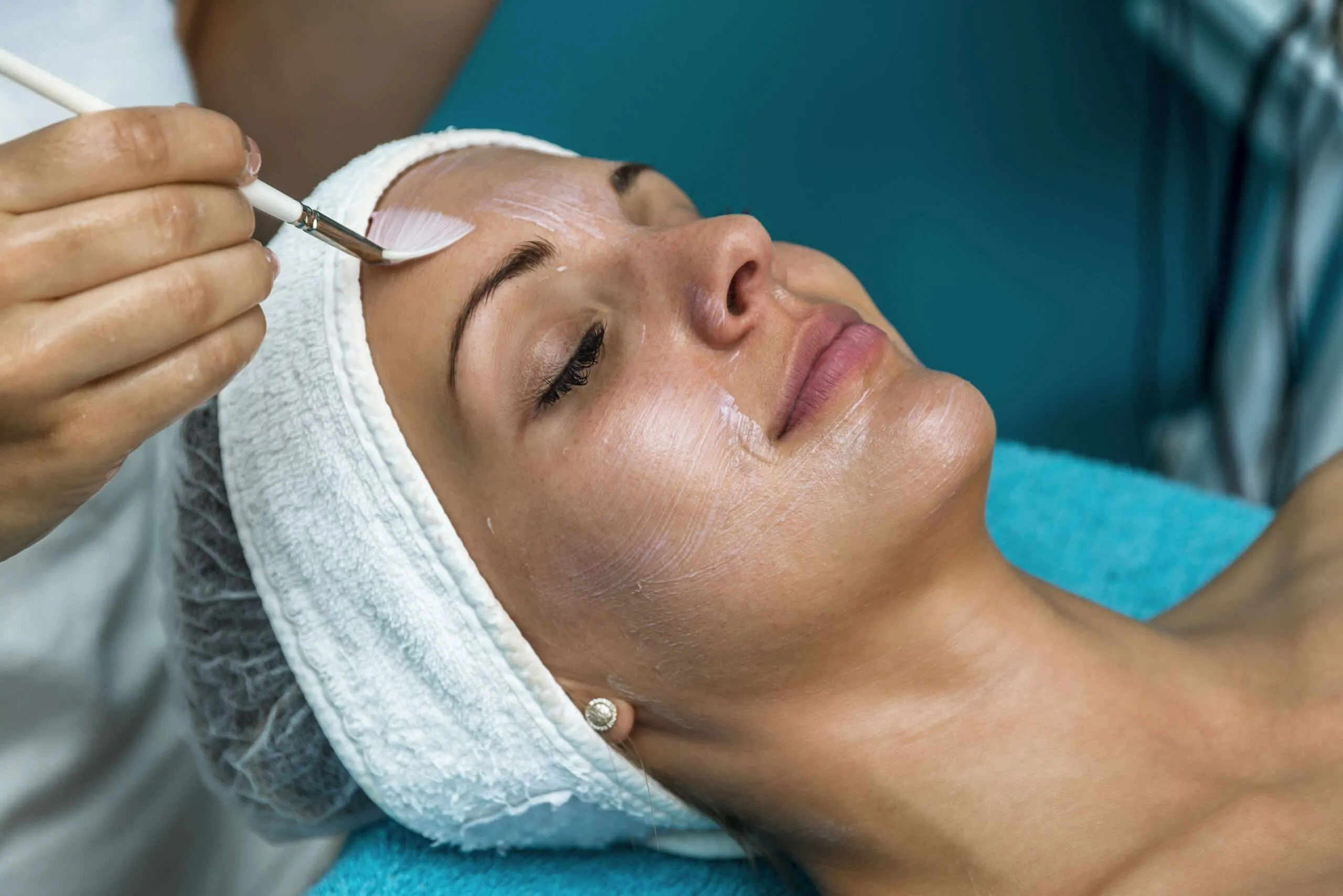Chemical Peel Image